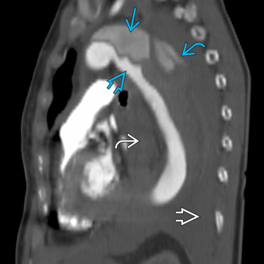 CTA in a 76-year-old woman with severe chest pain shows an aneurysmal aorta with a type B dissection with true
and false
lumens. The false lumen has ruptured
, leading to extensive mediastinal hematoma
and hemothorax
.