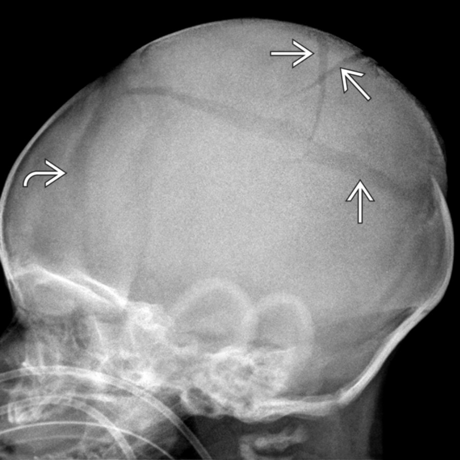 Lateral radiograph shows multiple fractures
that cross sutures & are diastatic. There is also coronal suture diastasis
.
