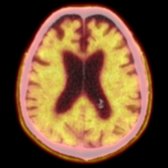 Axial fusion F-18 florbetapir PET/CT in the same patient confirms activity correlates to gray matter
, consistent with Aβ deposition.