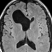 Axial FLAIR MR shows a porencephalic cyst
in the right frontal lobe communicating with the right frontal horn.
