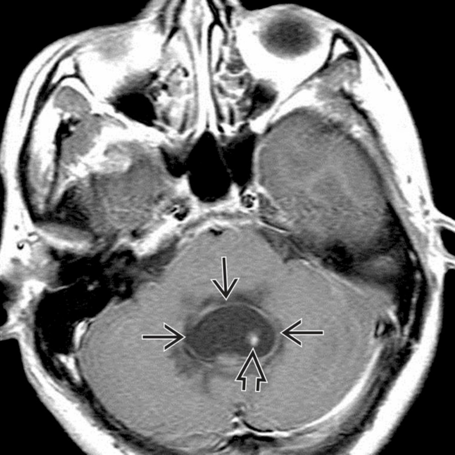 Axial T1 C+ MR in a patient with hydrocephalus shows rim-enhancing isolated 4th ventricular NCC
with enhancing scolex
.