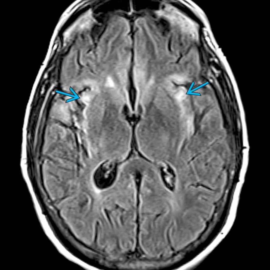 Axial FLAIR MR shows bilateral hyperintensity of the insular cortex
in this patient with ovarian cancer, consistent with autoimmune paraneoplastic encephalitis.