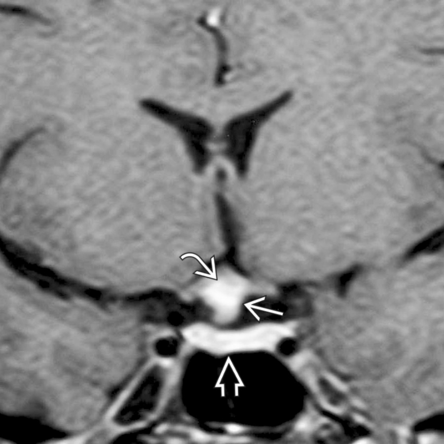 Coronal T1 C+ MR shows an enhancing suprasellar mass
separate from the pituitary gland below
. Note involvement of the optic chiasm
.