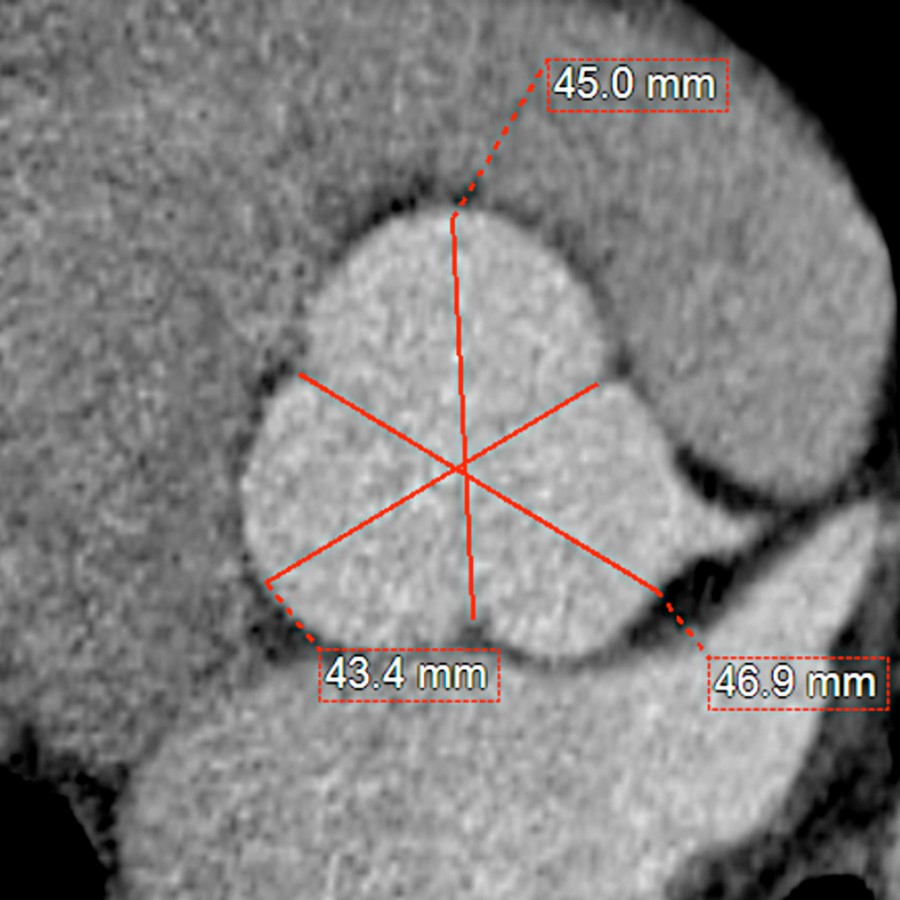 Axial CECT in a young patient with MFS shows symmetric dilation of all sinuses of Valsalva.