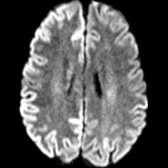 Axial DWI MR in a patient with sCJD shows typical bilateral asymmetric (right > > left) cortical diffusion restriction
with sparing of perirolandic cortex
.