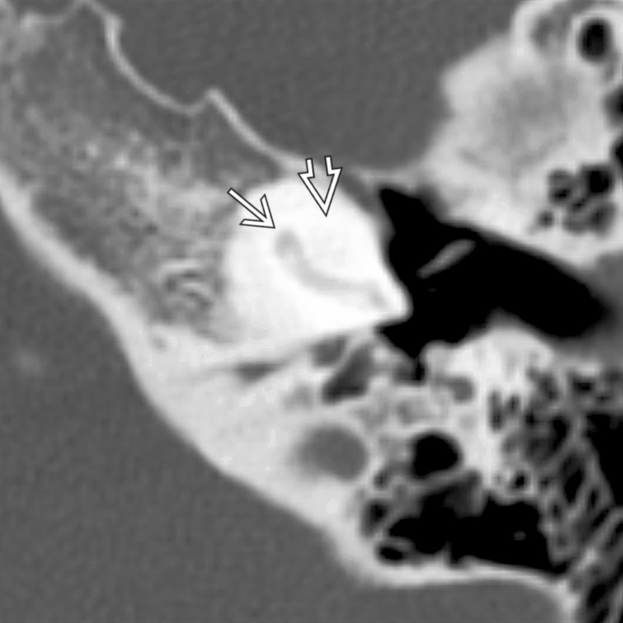 Axial bone CT shows severe labyrinthine ossificans. Notice that the basal turn of the cochlea is partially ossified but still identifiable
whereas the 2nd turn is nearly invisible
.