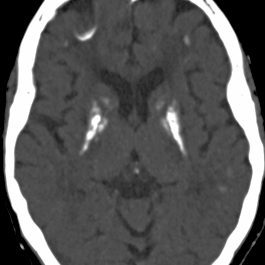 Axial NECT in a patient with pseudohypoparathyroidism shows dense Ca⁺⁺ within the BG & subcortical WM in a pseudohypoparathyroidism patient. There is significant imaging overlap between systemic diseases with abnormal calcium deposition.