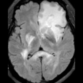Axial FLAIR MR in a patient with NMO shows multiple characteristic brain lesions. A large tumefactive lesion with ill-defined borders is seen in the left frontal lobe
. An ill-defined hyperintense lesion is seen involving the posterior limb of right internal capsule
, and there is involvement of the splenium of corpus callosum
in a unique "arch bridge" pattern.