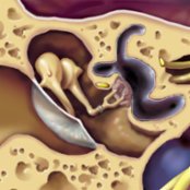 Coronal graphic illustrates findings of fenestral otosclerosis with a "donut" otospongiotic plaque
surrounding the stapes footplate in the oval window. The crisp margins of the oval window are obscured by plaque.