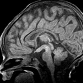 Sagittal T1 MR in a patient with duplicated pituitary glands shows a thickened floor of sella and fusion of the tuber cinereum and mammillary bodies (tuberomammillary fusion)
. Note the absence of a midline sella turcica and pituitary infundibulum.