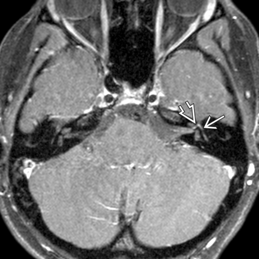 Axial T1 C+ FS MR demonstrates enhancement of the labyrinthine
and tympanic
segments of the intratemporal facial nerve. Mastoid segment enhancement was also present (not shown).