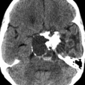Axial NECT shows a low-attenuation suprasellar mass with rim
and globular
Ca⁺⁺. Note the fluid-fluid level formed by intracystic keratin debris
.