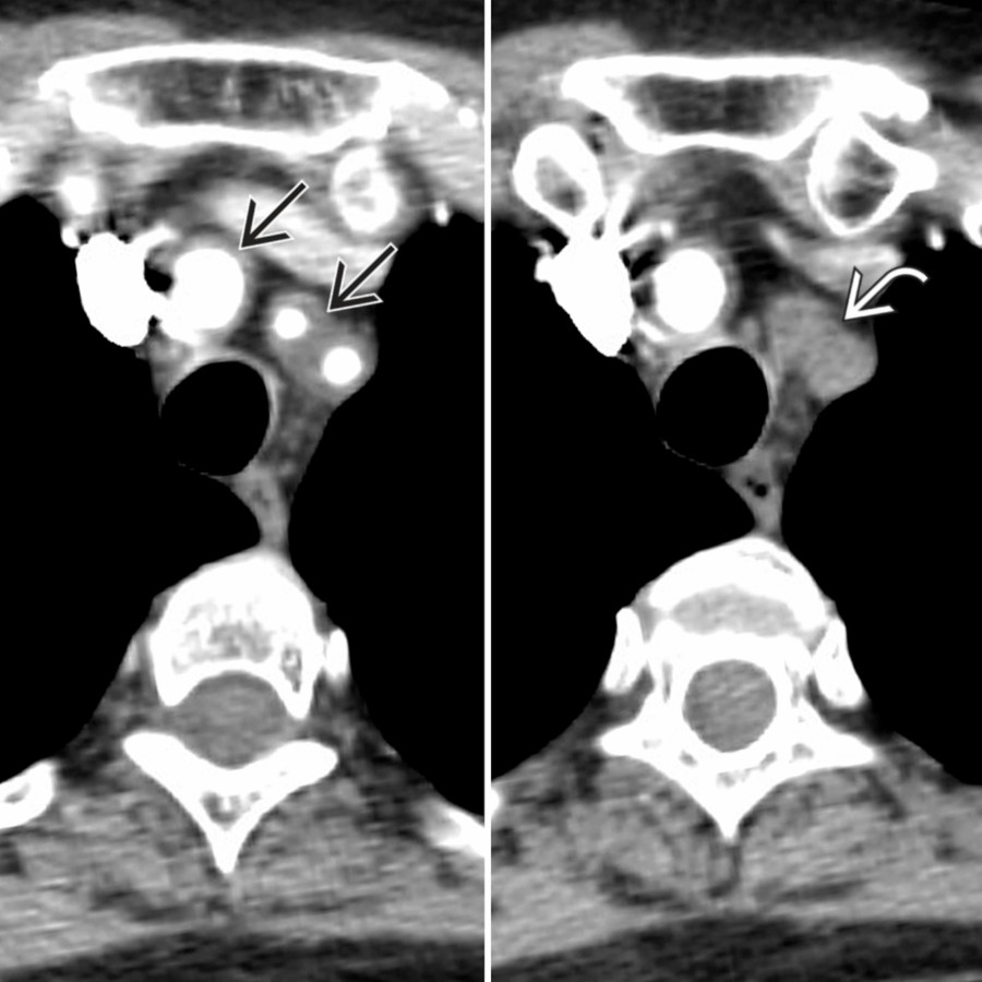 Composite image with axial CECT shows wall thickening
of the proximal right brachiocephalic, left common carotid, and left subclavian arteries. There is more distal occlusion
of the left common carotid and left subclavian arteries. The left subclavian artery is the most common branch vessel affected in patients with TA.