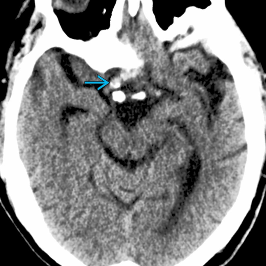 Axial NECT shows a fusiform, partially calcified mass in the suprasellar cistern
that represents an ectatic, supraclinoid, internal carotid artery (ICA) with calcified atherosclerotic plaque. Coronal and sagittal reformatted images make this diagnosis straightforward.