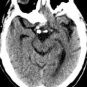 Axial NECT shows a fusiform, partially calcified mass in the suprasellar cistern
that represents an ectatic, supraclinoid, internal carotid artery (ICA) with calcified atherosclerotic plaque. Coronal and sagittal reformatted images make this diagnosis straightforward.
