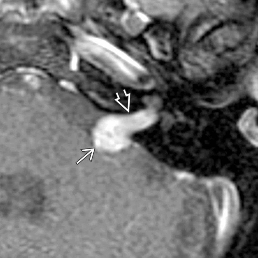Axial T1 C+ FS MR shows typical mid sized CPA-IAC vestibular schwannoma. "Ice cream" (CPA component)
"on cone" (IAC component)
morphology is highly suggestive of this diagnosis.