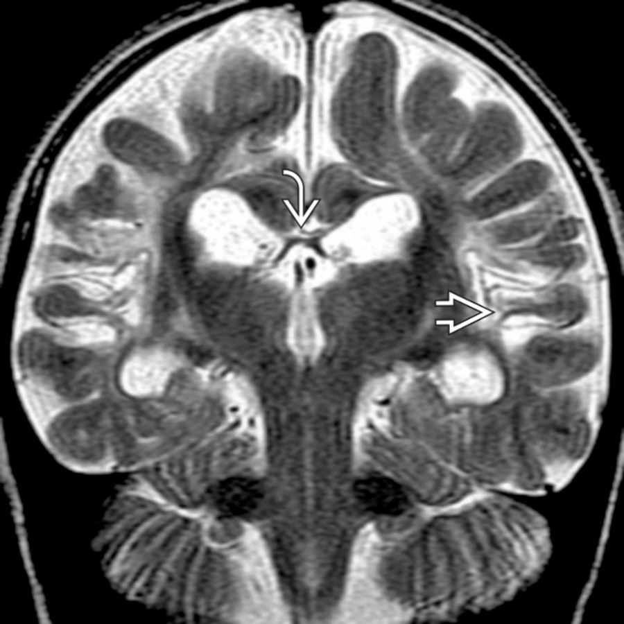 Coronal T2 MR shows parietal ulegyria
& marked thinning of the posterior corpus callosum
.