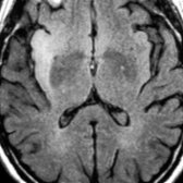 Axial FLAIR MR in an older adult with small cell lung cancer and subacute dementia shows striking hyperintensity in the right insula
.