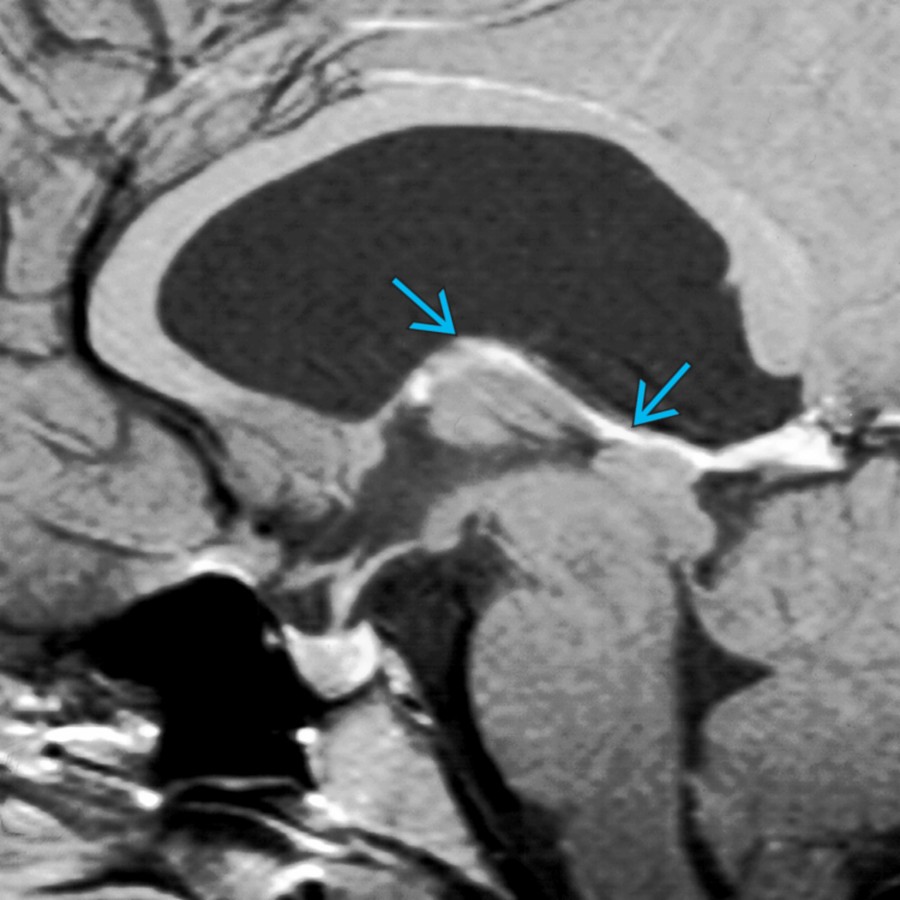 Sagittal T1 C+ MR shows a large CSP/CV that extends from just behind the corpus callosum genu all the way posteriorly to the splenium. The fornices are not visible, and the internal cerebral vein is flattened
.