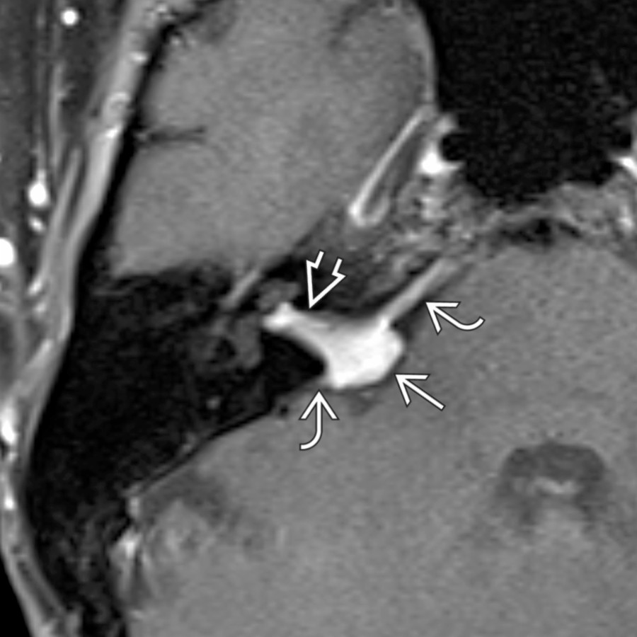 Axial T1 C+ FS MR in a patient with right HFS shows an avidly enhancing mass with the configuration of "ice cream" (CPA component)
"on cone" (IAC component)
. Note enhancing dural tails
, which help differentiate this histologically-proven CPA-IAC meningioma from a schwannoma.