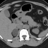 Axial NECT in a 34-year-old woman with elevated 24-hour urine cortisol and Cushing syndrome shows a low-attenuation (HU -6) right adrenal mass
, confirmed to be an adrenal adenoma at surgical pathology.