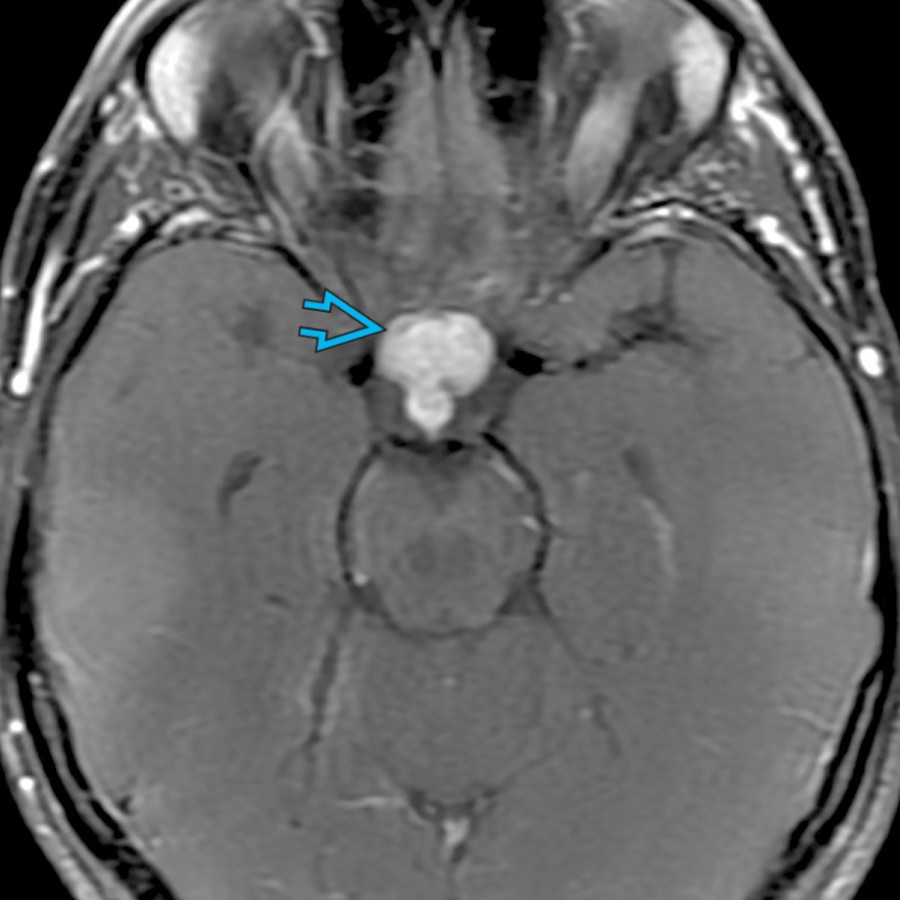 Axial T1 C+ FS MR shows a lobular, enhancing suprasellar mass
related to neurosarcoid. Patients with neurosarcoid often have associated pulmonary hilar adenopathy.