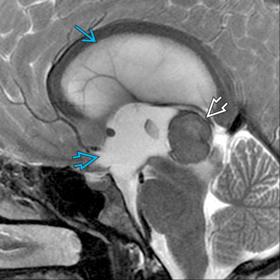 Sagittal T2WI MR shows obstructive hydrocephalus with markedly enlarged lateral
and 3rd
ventricles. The CSF suprasellar mass was related to an enlarged 3rd ventricle from a pineal region germinoma
. Germinomas most commonly present in the pineal region.