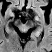 Axial FLAIR in same patient shows subtle periaqueductal hyperintense signal
. Note decreased AP diameter of the midbrain due to atrophy. AP diameter < 17 mm has 75% positive predictive value in differentiating progressive supranuclear palsy from multisystem atrophy.