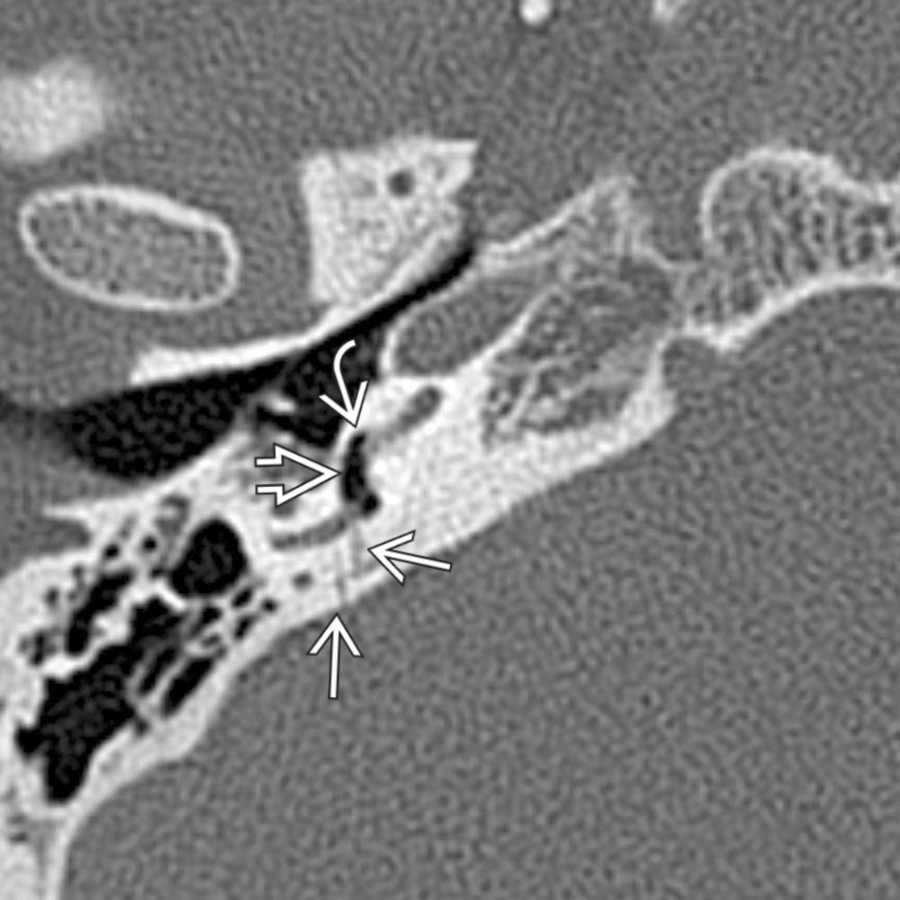 Axial bone CT in a patient with multiple skull base fractures secondary to a high-speed collision shows fractures
traversing the left temporal bone, crossing the right posterior limb of the lateral semicircular canal with associated pneumolabyrinth in the vestibule
and basal turn of the cochlea
.
