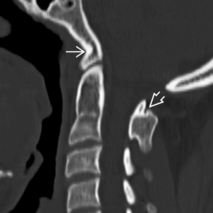 Sagittal bone CT shows the anterior arch of C1 fused to the clivus
and posterior arch fused to C2
.