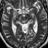 Axial T2 MR shows abnormal hyperintensity in the right medial temporal lobe
, typical of limbic encephalitis. Note the abnormal hyperintensity in the midbrain
, indicative of brainstem encephalitis. Brainstem encephalitis is a very uncommon paraneoplastic syndrome. Multiple paraneoplastic syndromes can occur in the same patient.