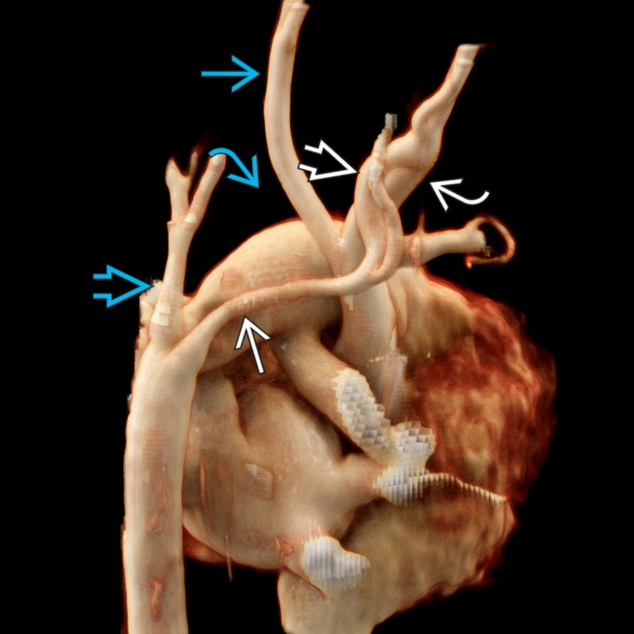 Posterior oblique CTA cinematic rendering shows type B interrupted aortic arch
with an aberrant right subclavian artery
. Also note the collateral vessel
with right carotid artery
. Left carotid artery
and left subclavian artery (LSA)
are also shown.