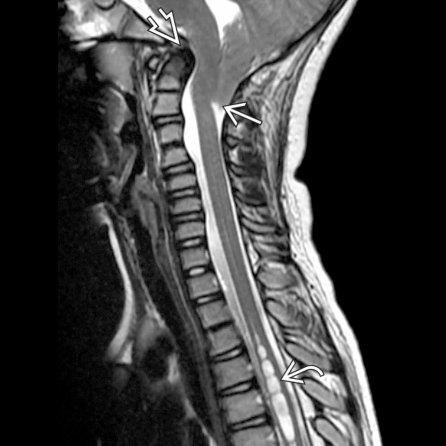 Sagittal T2 MR in a patient with occipital headaches shows a significantly pointed configuration of a low-lying cerebellar tonsil
to the level of the midposterior ring of C2. Notice also the dorsally tilted dens
, effacement of CSF at the foramen magnum, and associated cervicothoracic syrinx
.
