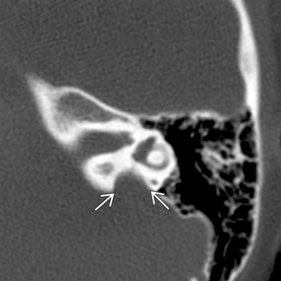 Axial bone CT in the same patient shows a markedly enlarged left vestibular aqueduct
, much larger than 2 mm at the operculum.