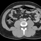Axial correlative CECT below the kidneys shows the quadratus lumborum muscle is more laterally located, and the psoas muscle is directly anterior to the erector spinae muscle.