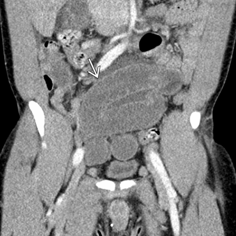 Coronal CECT demonstrates multiple dilated loops of small bowel
in the pelvis, compatible with small bowel obstruction.