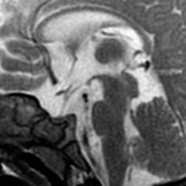 Sagittal T2 MR in a patient with complete absence of the posterior pituitary bright spot shows a small sella turcica and pituitary gland
. The optic apparatus
is also hypoplastic. A clearly defined pituitary stalk
is present.