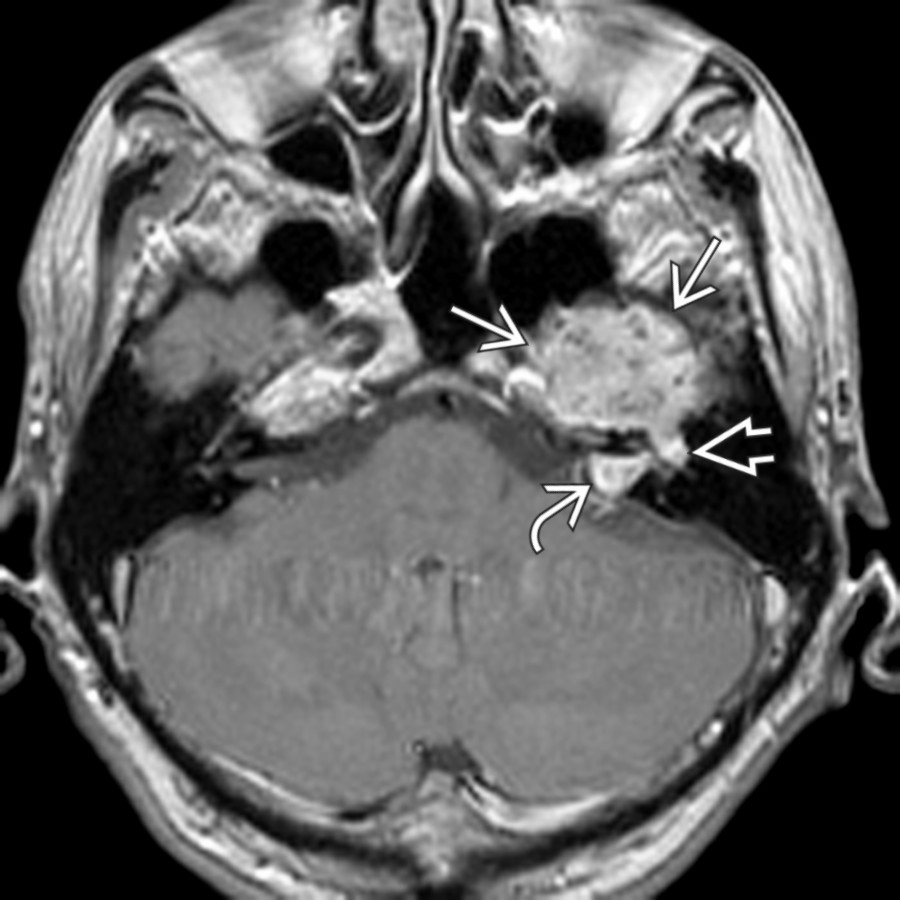 Axial T1 C+ MR shows an enhancing mass
projecting into the medial middle cranial fossa from the greater superficial petrosal nerve. FNS diagnosis is suggested if the projections along the tympanic CNVII
and along the labyrinthine CNVII into the internal auditory canal
are seen.
