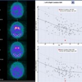 Quantitative analysis of I-123 ioflupane SPECT shows the bilateral caudates have abnormally low uptake
of radiotracer compared with normal controls. Note that this would be difficult to discern on visual analysis alone
.