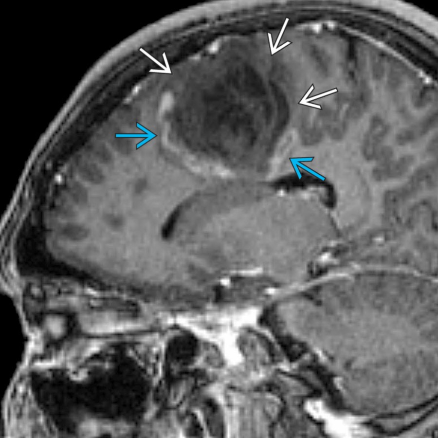 Sagittal T1 C+ MR in the same patient shows the borders of the large lesion nearest to the cortex to be nonenhancing
as compared to the other margins
. This open ring appearance can help distinguish tumefactive MS from abscess or neoplasm (which more typically have complete ring enhancement).