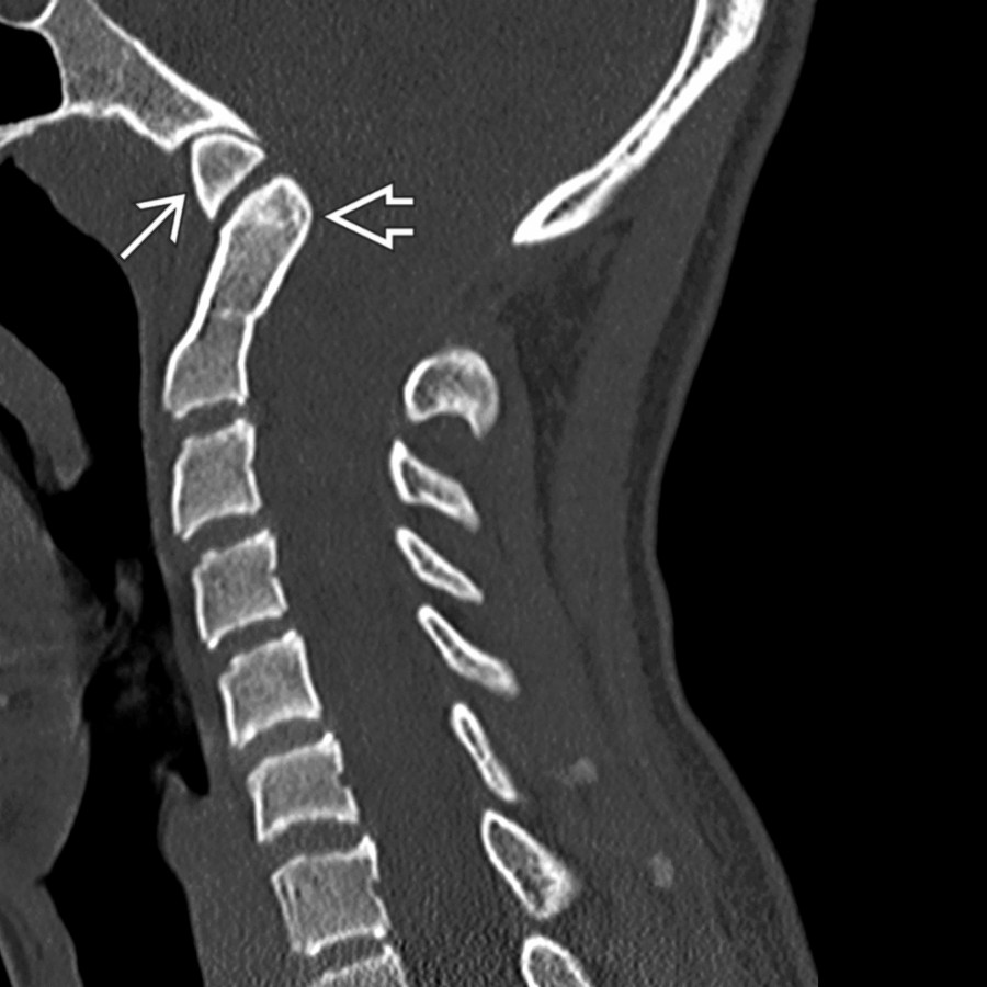 Sagittal bone CT in a patient with hyperreflexia and severe CM1 demonstrates odontoid retroflexion
and enlargement of the anterior C1 ring
(which abnormally articulates with the remodeled clivus).