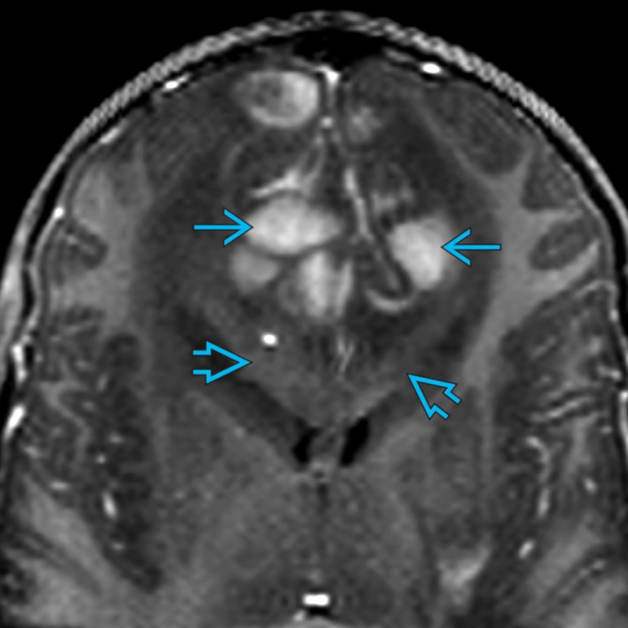 Coronal oblique T1 C+ MR in an 11 year old with CNS lymphoma shows bifrontal areas of enhancement
, which corresponded to hyperdense areas on CT (not shown). Note the abnormally thickened corpus callosum
that is infiltrated by a nonenhancing tumor.