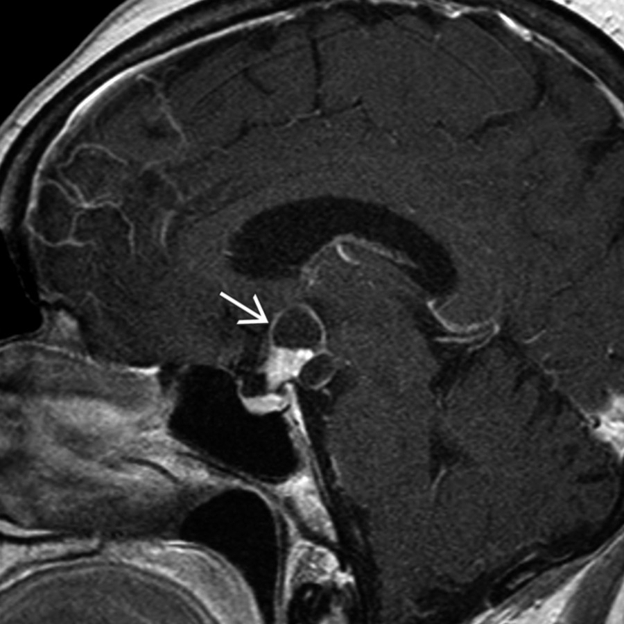 Sagittal T1 C+ MR shows an enhancing, partially solid and cystic suprasellar mass
related to an adamantinomatous craniopharyngioma. These WHO grade 1 tumors are the most common pediatric intracranial tumor of nonglial origin.