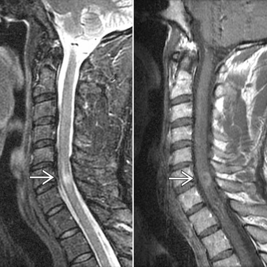 Sagittal T2 (left) & T1 C+ MR (right) show an active plaque at the C6-C7 level with ring enhancement & focal T2 hyperintensity
.