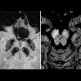 Axial SWI MR (left) in a 14-year-old girl with BPAN shows excessive iron, maximum in substantia nigra (SN)
, compared to GP
. Axial T1WI MR (right) shows the pathognomonic bilateral symmetric linear oblique T1 high signal in SN with central low-T1 band
.