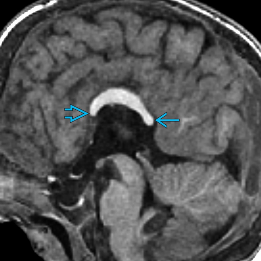 Midline sagittal T1 MR in a 7 year old with multiple anomalies shows a short, thin, & dysmorphic CC with a poorly formed splenium
& rostrum
.
