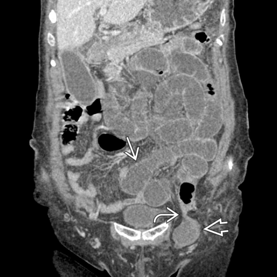 Coronal CECT demonstrates small bowel extending into an inguinal hernia
with a transition point
and dilatation of the proximal small bowel
, compatible with bowel obstruction.