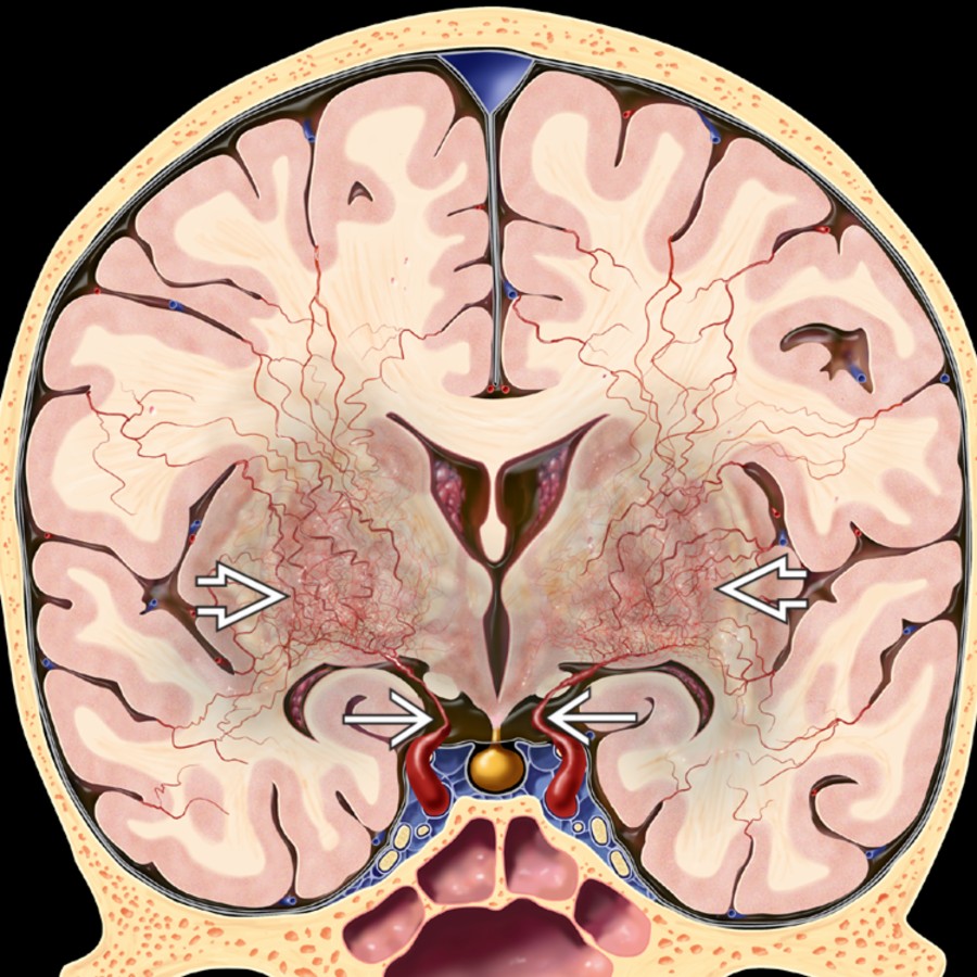 Coronal graphic shows severe tapering of both distal internal carotid arteries (ICAs)
and strikingly enlarged lenticulostriate arteries
coursing through basal ganglia. This is the puff of smoke (moyamoya) pattern.
