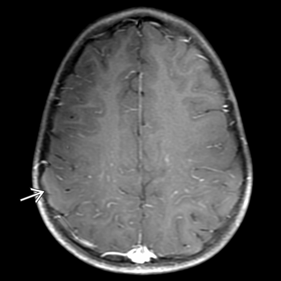 Axial T1 C+ FS MR in the same patient reveals subtle leptomeningeal enhancement
over the right parietal lobe. This constellation of findings represents cerebral cortical encephalitis, a finding unique to MOGAD and potentially predisposing to seizures.