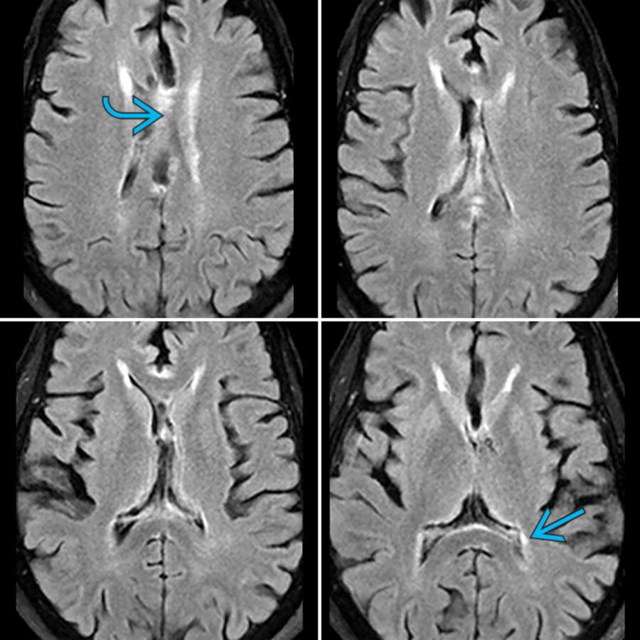 Axial FLAIR MR in the same patient 1 month after placement of the shunt shows mild decrease in the hyperintensities in the CC
as well as the periventricular white matter
with further decompression of the lateral and 3rd ventricles.